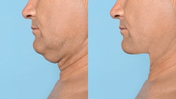 Which Non-Surgical Treatments Work Best for Jowls and Loose Skin Elstree?