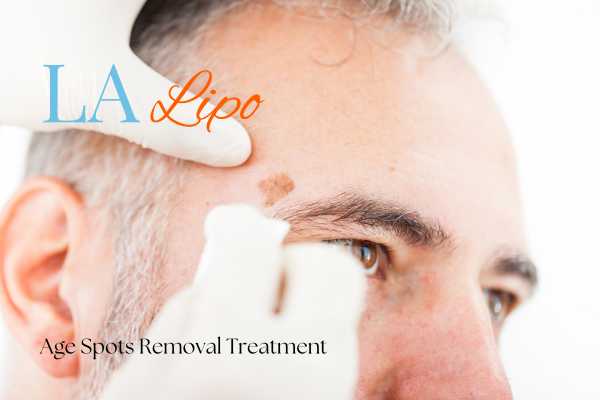 What Are the Most Effective Treatments for Age Spots Elstree?