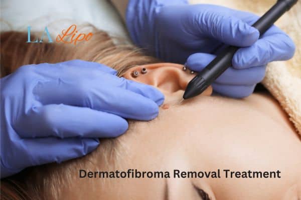 Dermatofibroma Removal Treatment Elstree