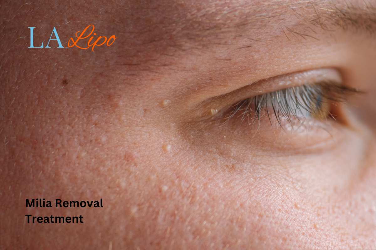 Cryopen Milia Removal: Is It the Easiest and Safest Option Elstree?
