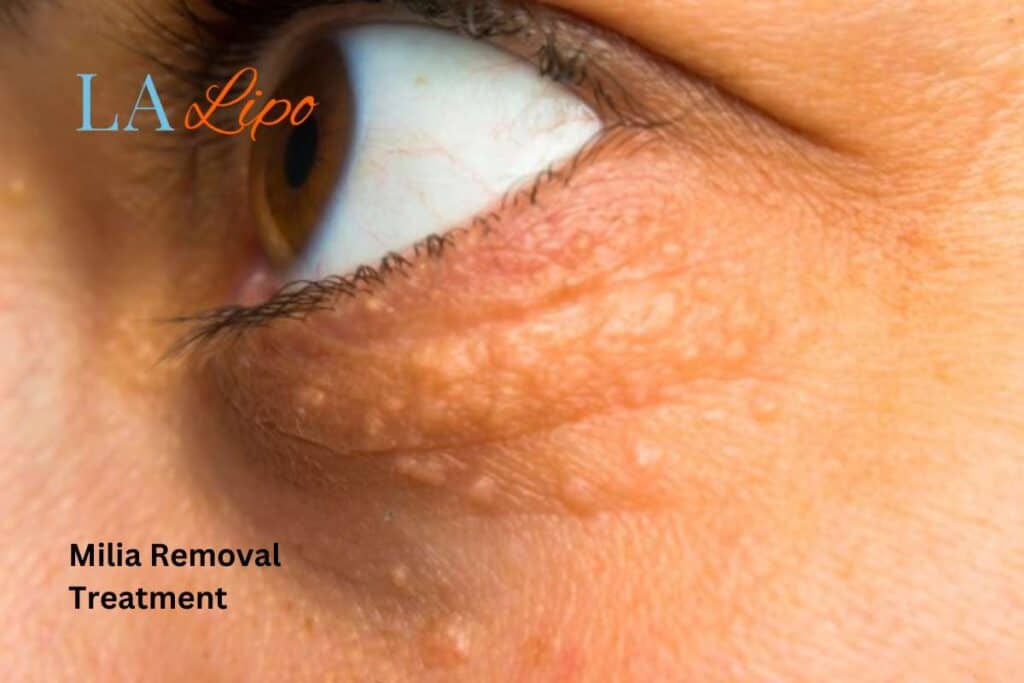 milia removal