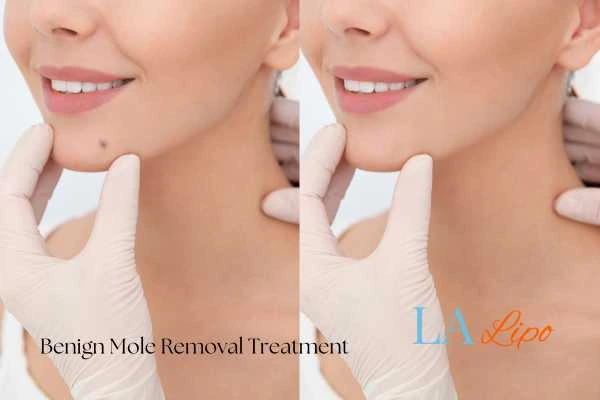 Before-and-after results following benign mole-removal treatment Elstree