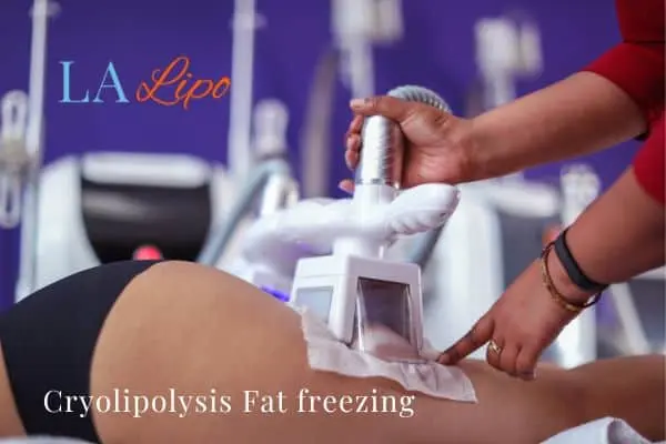 women getting fat freezing Elstree