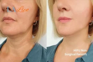 hi-fu for wrinkles Elstree before and after results