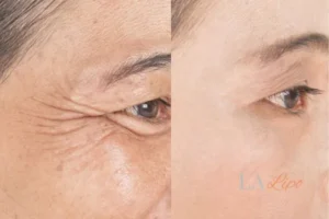 Before and after results of woman - HI-fu wrinkles reduction treatment Elstree