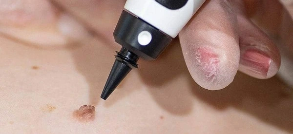 skin tag removal using cryopen Elstree