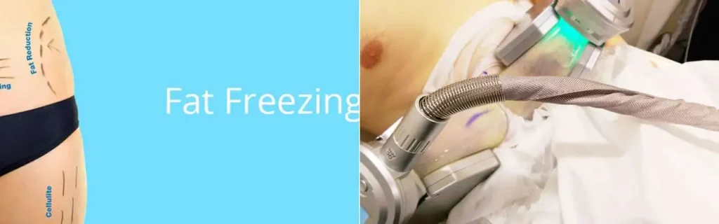 Fat freezing Elstree on multiple areas of the body
