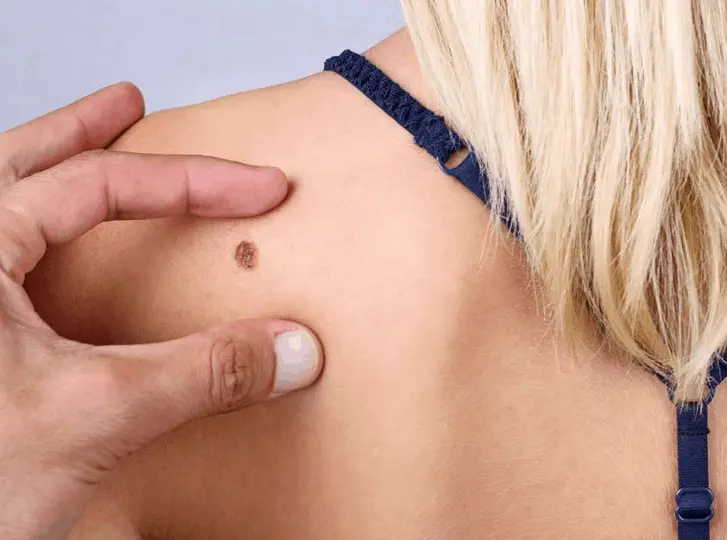 woman having mole removal Elstree consultation before treatment.