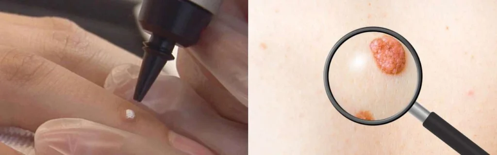 CryoPen practitioner Elstree assessing a benign mole before treatment