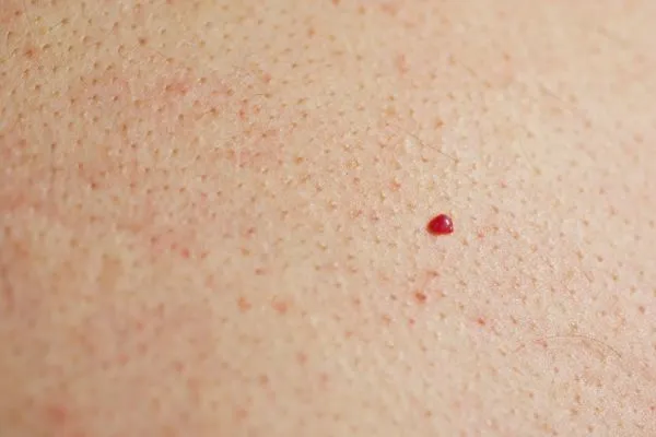 close up of a cherry angioma Elstree
