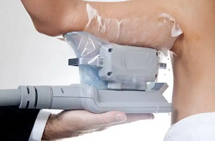 Picture of fat freezing Elstree on the upper arms.