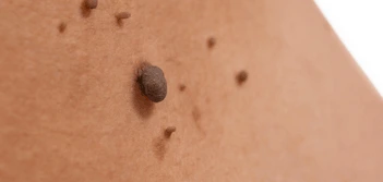 image of a skin tag Elstree