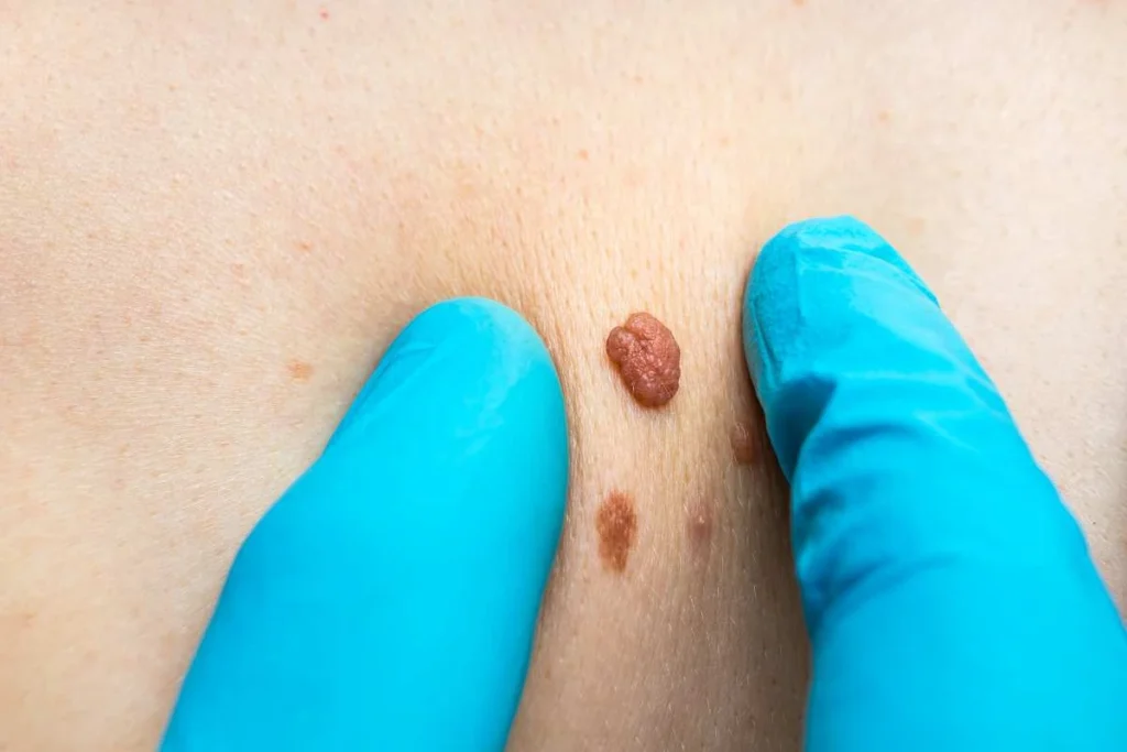 Consultant examining a skin tag Elstree
