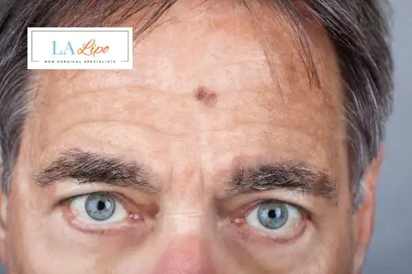 Solar Lentigo Removal Elstree image of man with mark on his forehead