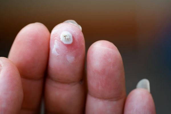 wart on person finger - cryotherapy to treat from LA LIPO Elstree