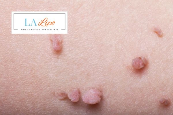 Does cryopen skin tag removal Elstree hurt? Find out now call our team today!