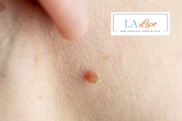 Book skin tag removal Elstree today speak to our team now!