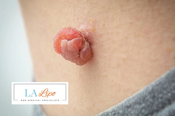 Interested in skin tag removal Elstree? Concerned about the pain? Find out more today!