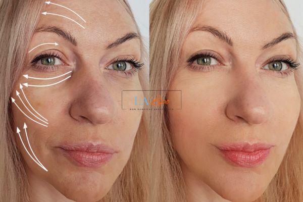 Morpheus 8 results Elstree face lift.
