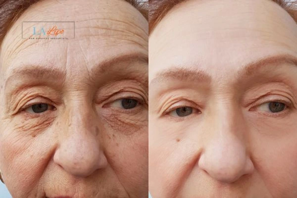 The powerful benefits of Morpheus8 Treatment Elstree - Call Our team today!