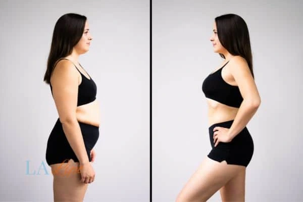 Picture of womans before and after using LA-EMS body sculpting to improve her core strength Elstree