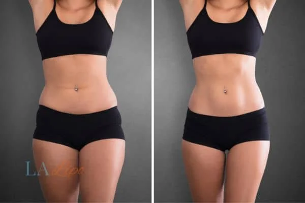 before and after results of non-surgical treatment to help a woman's body image and mental health Elstree