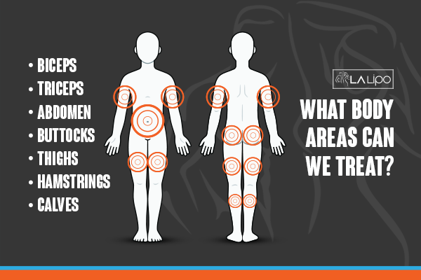 Diagram to show areas you can have LA-EMS Body Sculpting Treatment Elstree