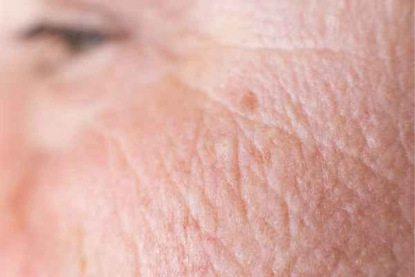 close up picture of a woman's face showing an age spot Elstree