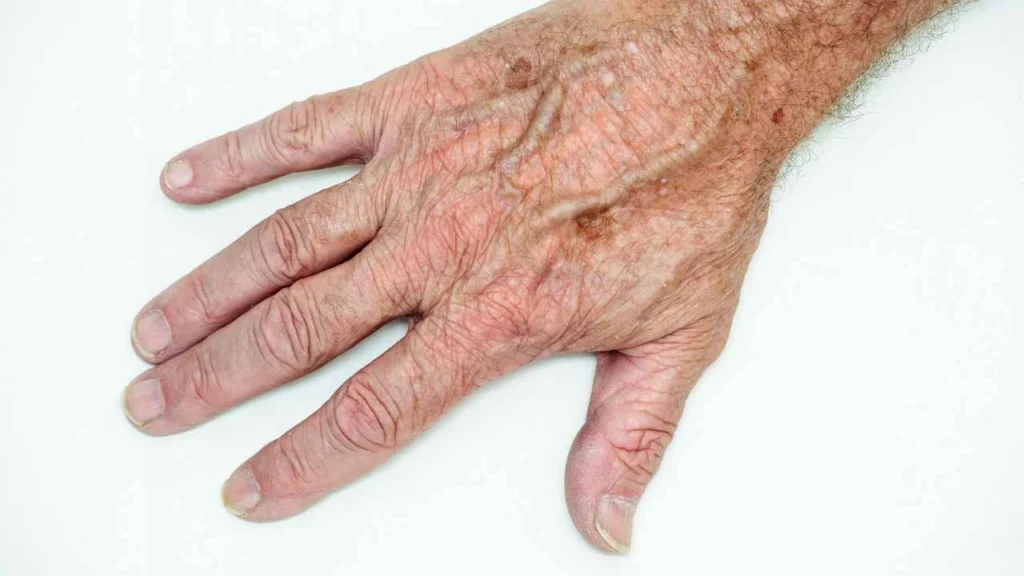 Male hand showing age spot Elstree
