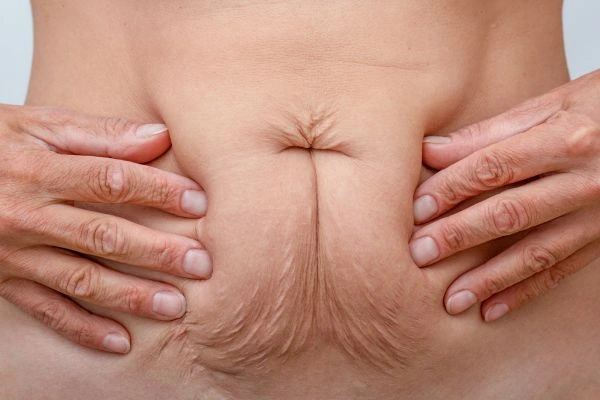 Should I Combine Diastasis Recti Treatment with Body Contouring for Better Results Elstree?