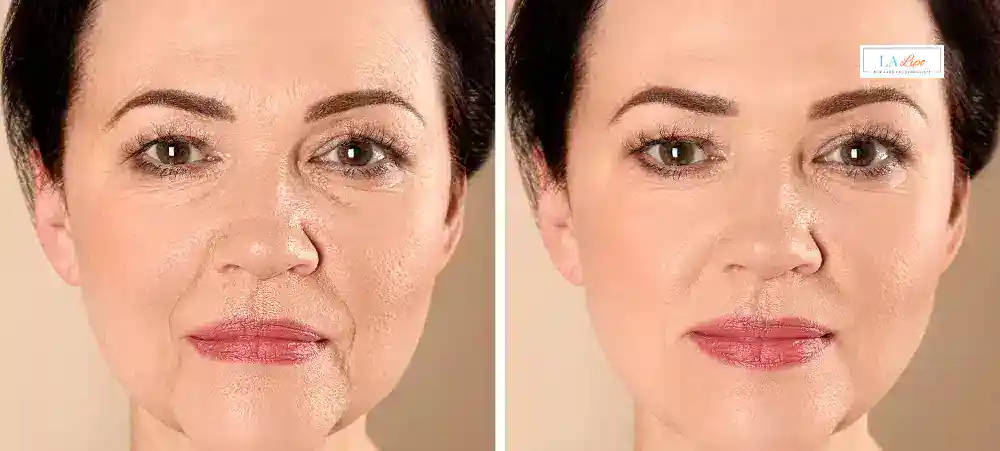 How Long Does It Take to See Results and How Long Do They Last Elstree?